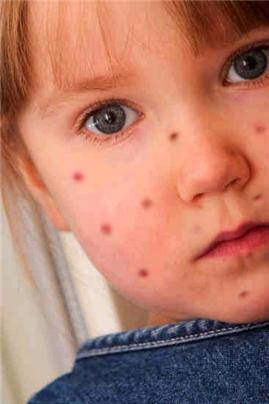 Niño afectado por varicela.