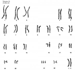 El cromosoma 21 es muy pequeño y aún así causa terribles problemas si tiene copias de más. 
