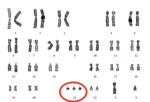 En un cariotipo, al alinear los cromosomas se puede ver una trisomía facilmente.