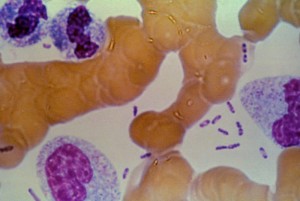 En la autopsia puede verse al microscopio Yersinia pestis junto a algunas células sanguíneas, eosinófilos.