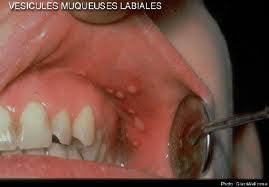 Aunque es raro el herpes labial puede darse dentro de la boca. De donde es muy dificil eliminarlo.
