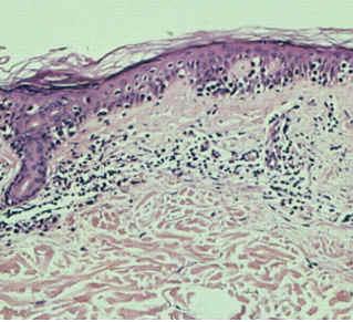 En la foto un corte histológico en el que se aprecia el crecimiento del hongo debajo de la epidermis.