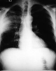 La neumonía puede diagnosticarse fácilmente por una radiografía en la que se verá el pulmón como en la foto se ve el derecho.