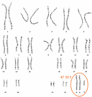 Cariotipo de un individuo con trisomía de los cromosomas sexuales, 47, XXY