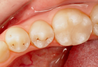 Las caries aparecen principalmente en las zonas de difícil acceso para el cepillo de dientes
