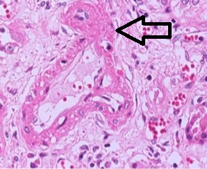 Corte histológico de riñon, donde se indica necrosis fibrinoide de la arteriola interlobular en un caso de Lupus nefrítico.