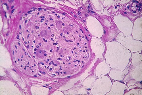 Corte transversal, al microscopio de un haz de neuronas de un nervio. En azul los núcleos y en rosa los cuerpos celulares.