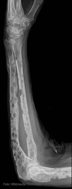 Durante un mieloma se pierde densidad osea, como se ve en la radiografia de un brazo de un afectado.